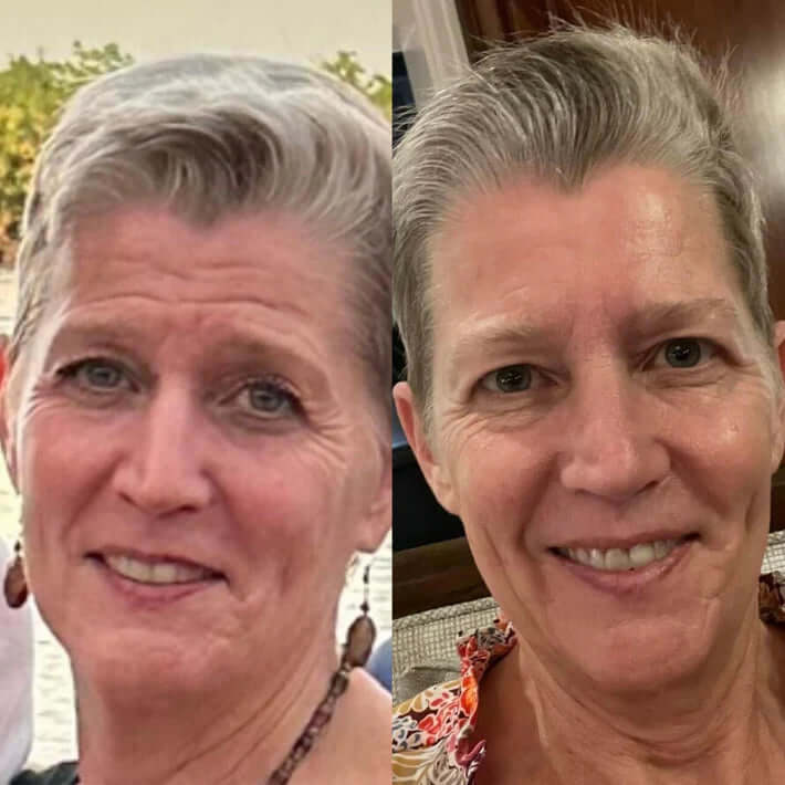 2+2 Gratis | Wiederverwendbare Anti-Falten-Patches | Schlafpads für Gesicht & Stirn | Glättet Linien & Falten über Nacht