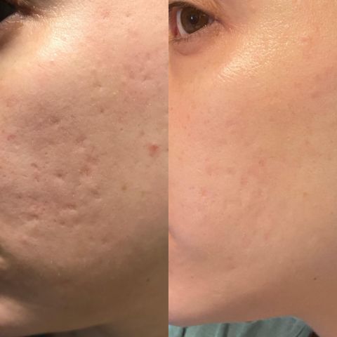 2+2 Gratis | Wiederverwendbare Anti-Falten-Patches | Schlafpads für Gesicht & Stirn | Glättet Linien & Falten über Nacht